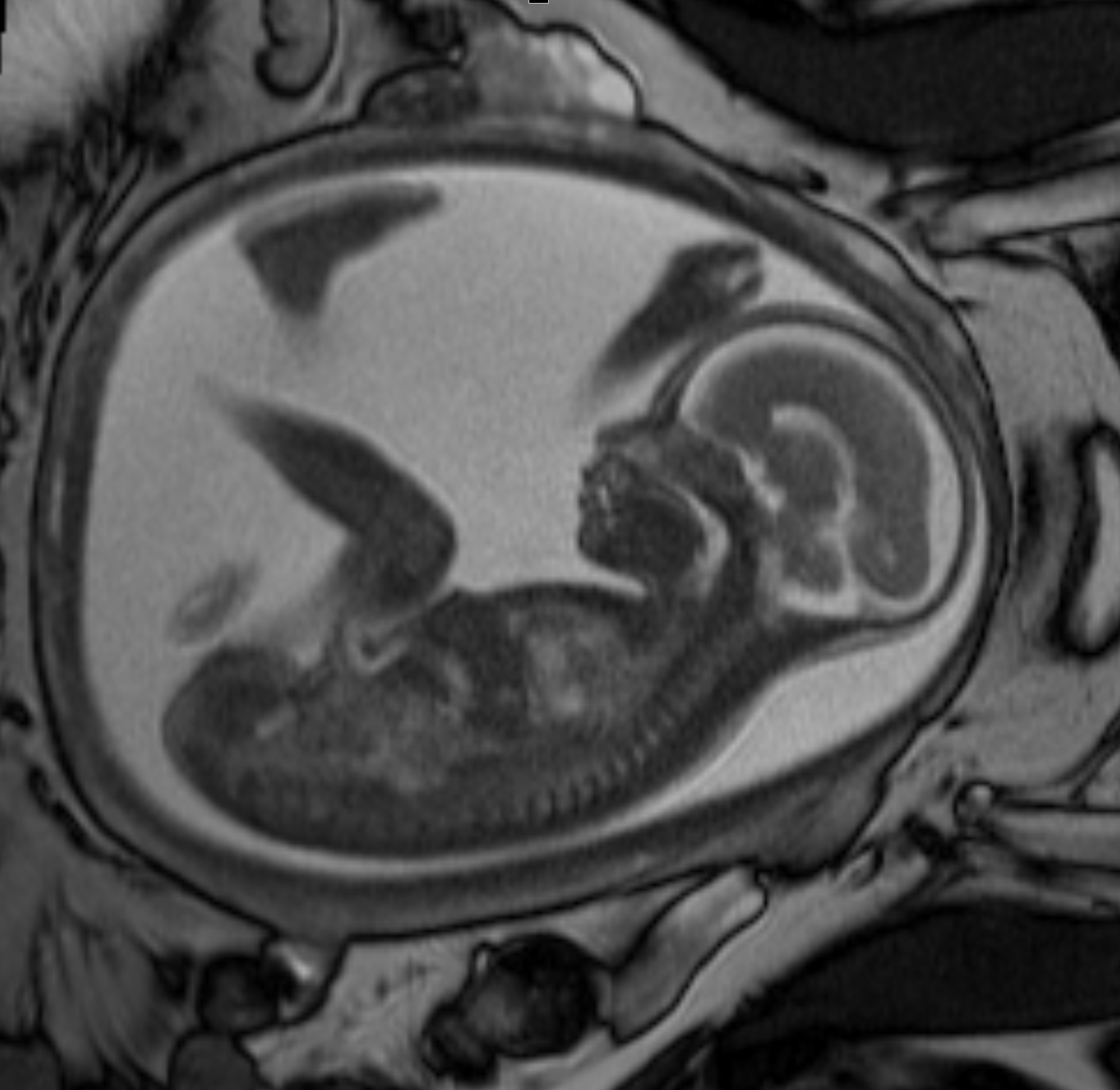 A fetal MRI showing normal development.
