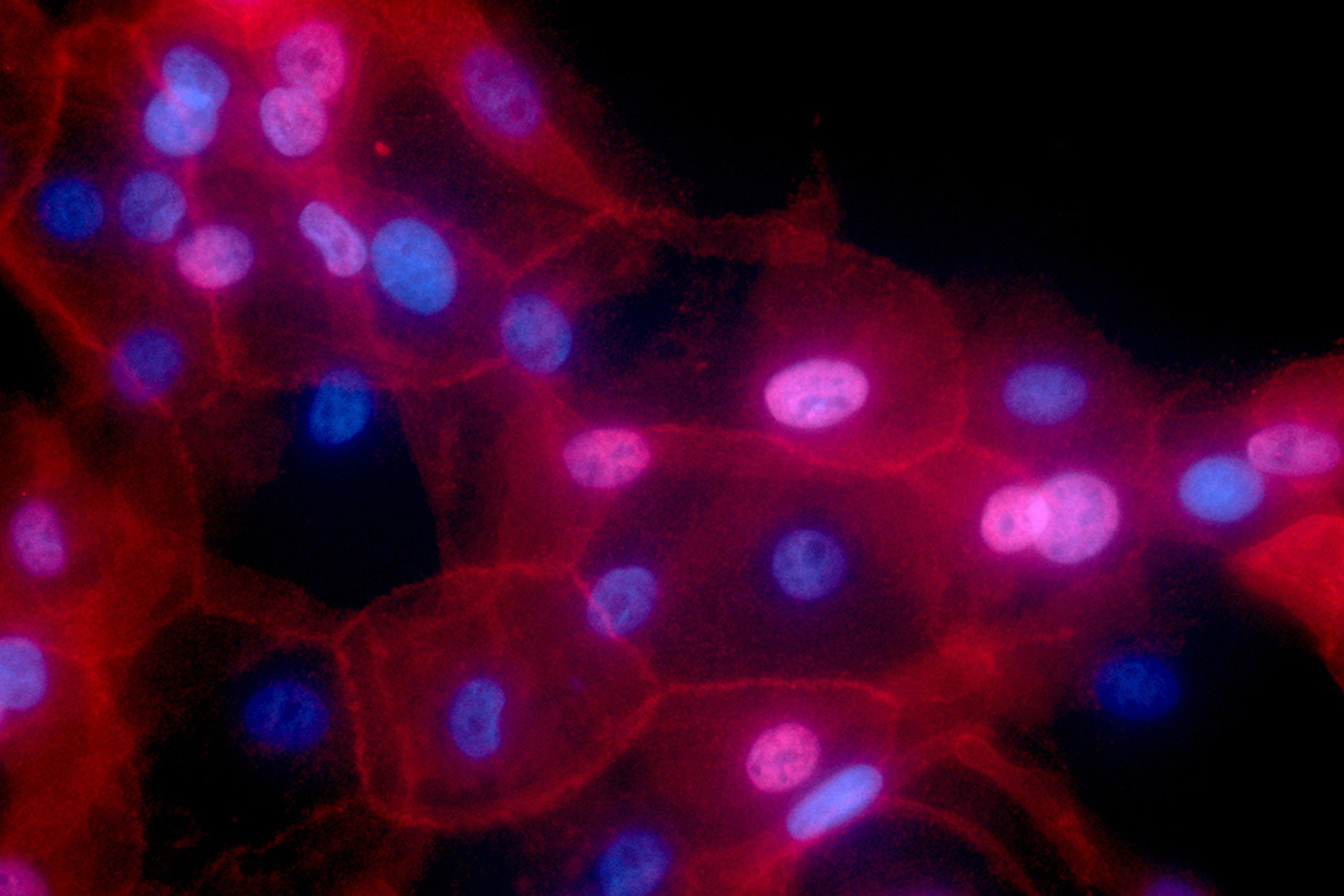 Human breast cancer cells appear as reddish shapes with blue and purple dots