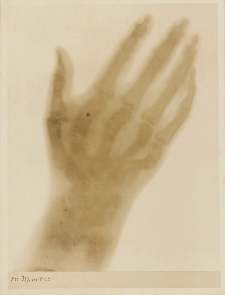 At an association “smoke talk” in 1896, Charles L. Norton, Class of 1893, presented an x-ray image of President Walker’s hand that revealed a piece of metal from a cannonball attack in the Civil War.