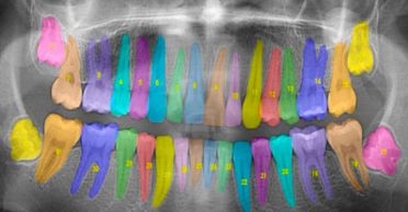 X-ray image of full set of teeth with teeth colored and numbered