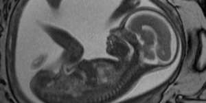 A fetal MRI showing normal development.