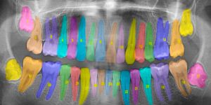 X-ray image of full set of teeth with teeth colored and numbered