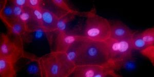 Human breast cancer cells appear as reddish shapes with blue and purple dots